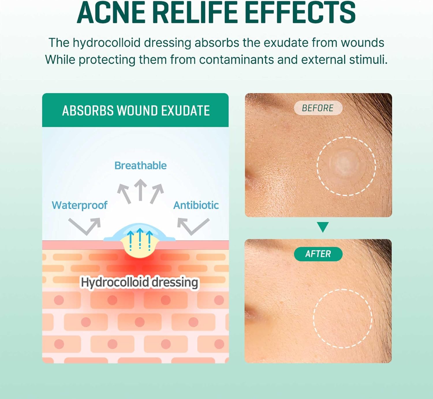 SOMEBYMI 30 Days Miracle Clear Spot Patch 18Patches